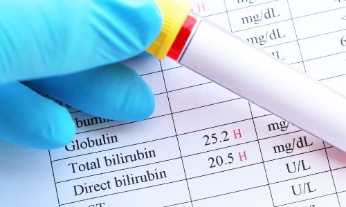 All you need to know about jaundice in newborns - blood